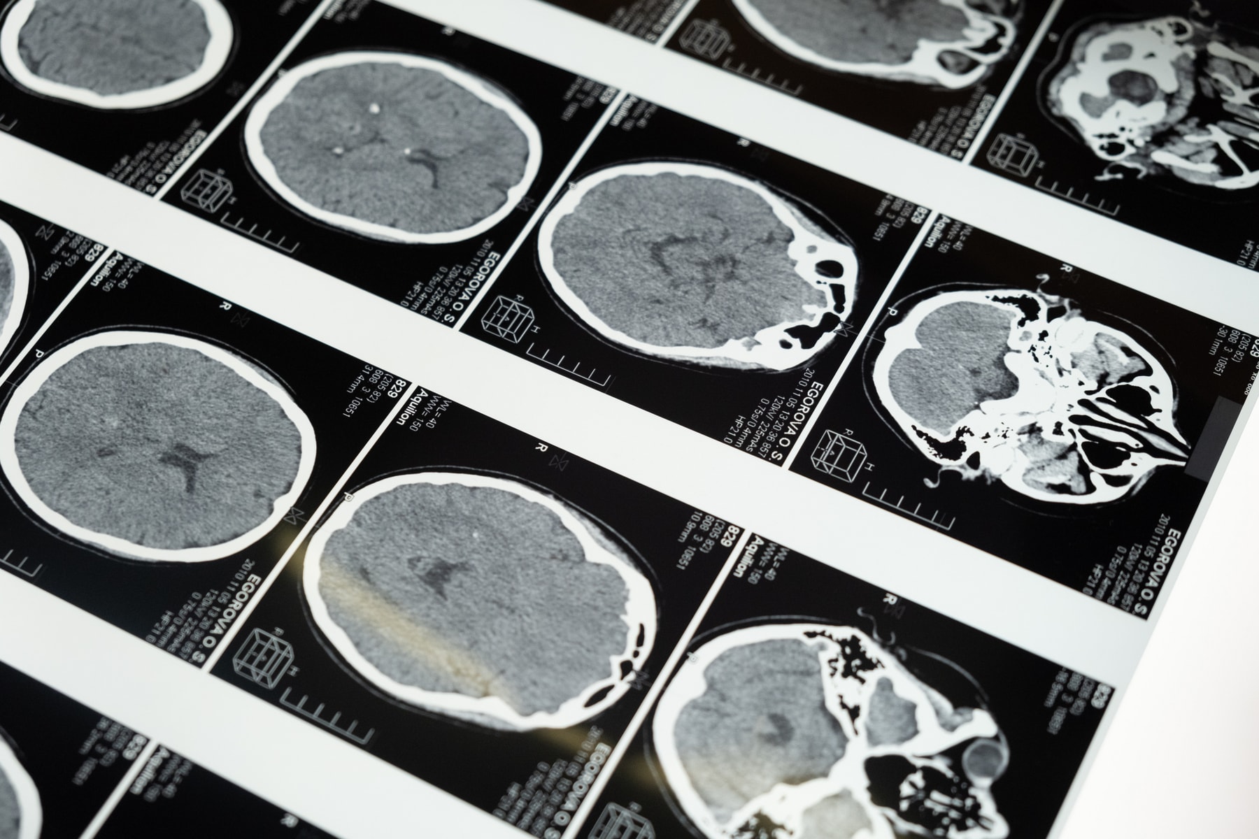 Epidiolex and the Treatment of Epilepsy